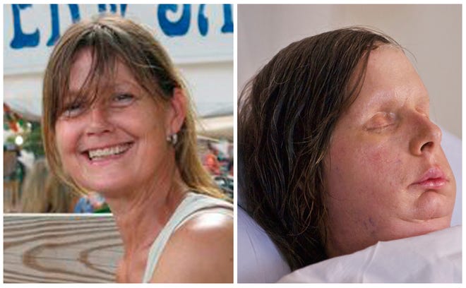 Undated photos provided Thursday, Aug. 11, 2011 by the Nash family and Brigham and Women's Hospital show chimpanzee attack victim Charla Nash before she was attacked by a chimpanzee and a recent photo release by the hospital Thursday Aug. 11, 2011 showing Nash after face transplant surgery, right. Nash was mauled by a chimpanzee in 2009 and received the transplant in May 2011 at Brigham and Women's Hospital in Massachusetts. Nash, 57, said in a statement she's looking forward to doing things she once took for granted, including being able to smell, eat normally, speak clearly and kiss loved ones.  (AP Photo/Brigham and Women's Hospital, Lightchaser Photography)