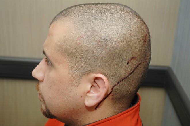 This Feb. 27, 2012 photo released by the State Attorney's Office shows George Zimmerman, the neighborhood watch volunteer who shot Trayvon Martin, with blood on the back of his head. The photo and reports were among evidence released by prosecutors that also includes calls to police, video and numerous other documents. The package was received by defense lawyers earlier this week and released to the media on Thursday, May 17, 2012.