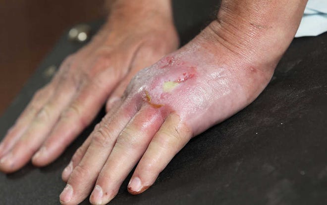 Glen Martin was bitten on the hand by a brown recluse spider and spent four days hospitalized in Lubbock. A brown recluse spider, like the one below, can inflict a painful and possibly life-threatening bite.