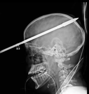 In this undated image provided by University of Miami/Jackson Memorial Hospital, a spear accidentally shot through Yasser Lopez's skull is seen. Lopez, 16, was in serious condition Tuesday, June 19, 2012, at Jackson Memorial Hospital's Ryder Trauma Center. Hospital officials say one of Lopez's friends was loading a speargun when it accidentally fired. Lopez was taken to the trauma center June 7 with roughly 3 feet of the spear protruding from his forehead. (AP Photo/University of Miami/Jackson Memorial Hospital)