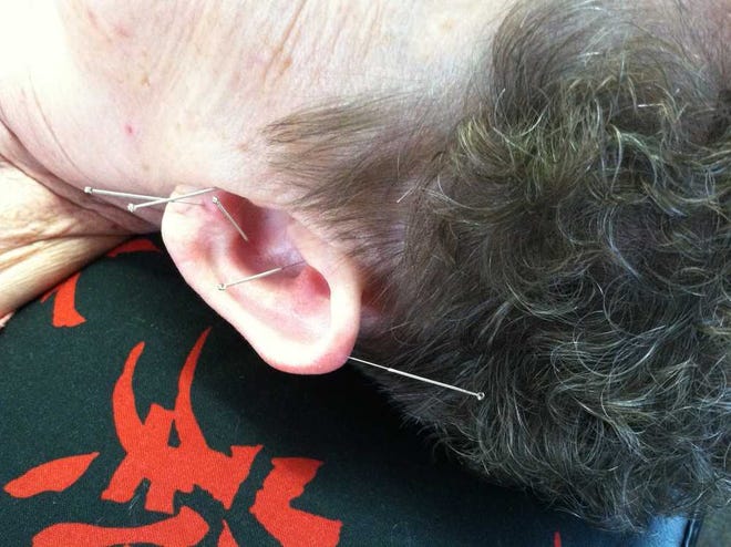 Five acupuncture needles are inserted into the left ear of Carbondale resident Mary McMillan, as well as in her right ear, feet, knees and hands, during a recent treatment.