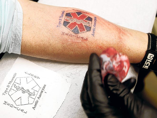 Tattoos a new way to alert about medical condition Tattoos a new way to alert about medical condition