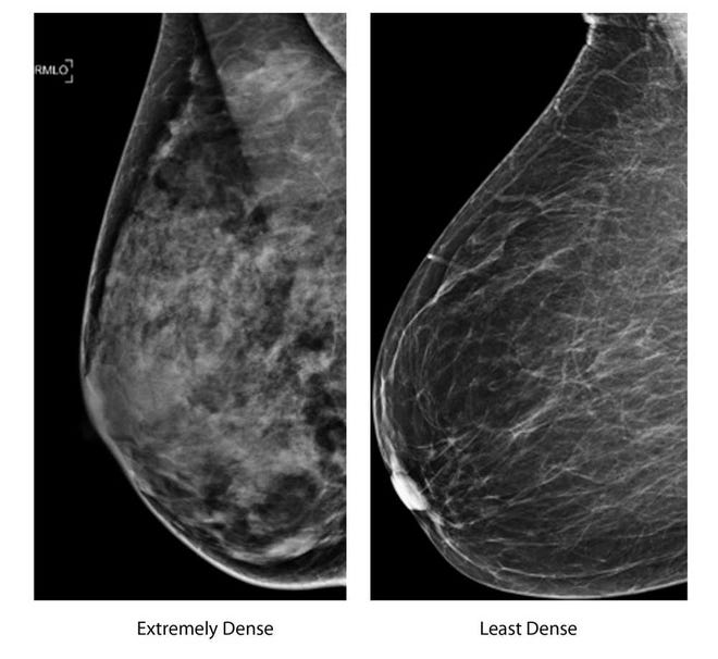 These two undated photos, provided by the American College of Radiology show an extremely dense breast, left, and a least dense breast. Women whose breast tissue is very dense have a greater risk of developing breast cancer than women whose breasts contain more fatty tissue. And it can be harder for mammograms to spot a possible tumor because both dense tissue and potentially cancerous spots appear white on the X-ray.