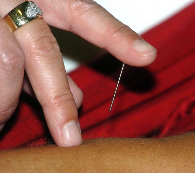 Licensed Acupuncturist Heather Malatesta (hand), of Turnersville, inserts an Acupuncture needle into the arm of patient Beth Murtaugh, of Burlington Township, at Lourdes Medical Center of Burlington County, on Sunset Road in Willingboro.