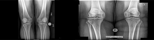 The X-ray on the left show the knee joints of a person of normal weight. The one on the right shows an obese patient's knees.