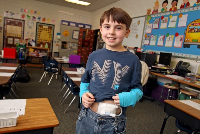 Tanner Denton, 9, shows off his tube that will be used once he begins dialysis. Tanner was diagnosed with Focal segmental glomerulosclerosis (FSGS) last year. He recently had surgery to remove a kidney and returned to school less than a week later