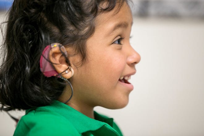 Angelica Lopez was born deaf but has received a brainstem implant to allow 
her to hear some sounds. Above, she attends a therapy session at the 
University of Southern California.AP PHOTO / DAMIAN DOVARGANES