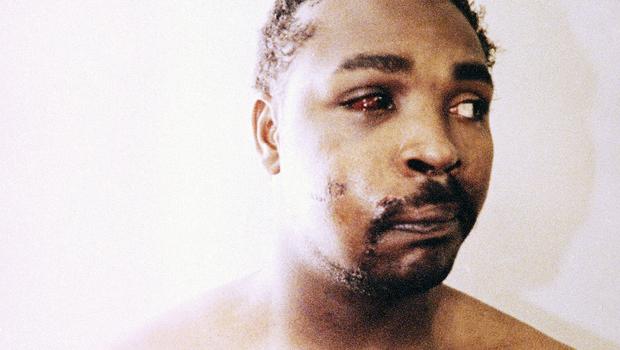 Rodney King beaten by LA police officers, showing a bloodied eye and cuts on his face