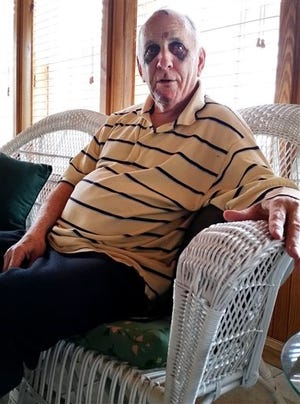 In this photo taken Friday, Aug. 14, 2015, a badly bruised Mayor Larry Barton sits in his home in Talladega, Alabama, discussing what he says was his recent beating by another man armed with a baseball bat. The attack was only the latest scrape for Barton, who once went to federal prison for stealing from the city but was re-elected to office. (AP Photo/Phillip Lucas)