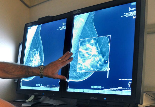A radiologist compares an image from earlier, 2-D technology mammogram to the new 3-D Digital Breast Tomosynthesis mammography in Wichita Falls, Texas. The technology can detect much smaller cancers earlier. Chances of dying from DCIS (ductal carcinoma in situ), a very early form of breast cancer are small but the disease is riskier for young women and blacks - disparities seen previously in more advanced cancer, according to a large study published Thursday, Aug. 20, 2015 in JAMA Oncology. TORIN HALSEY/TIMES RECORD NEWS