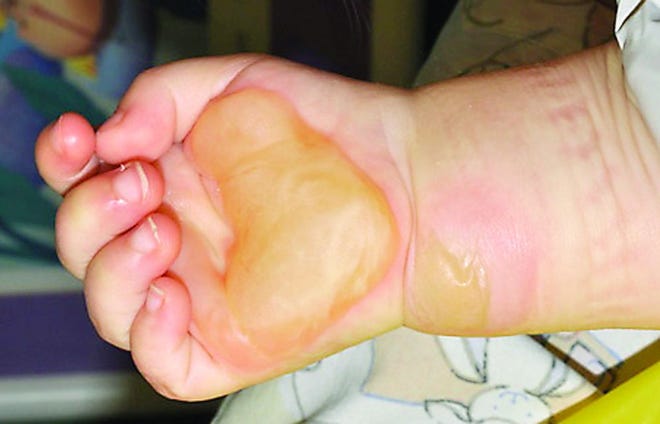 Courtesy photo

Close-up of a hand with a burn blister before treatment.