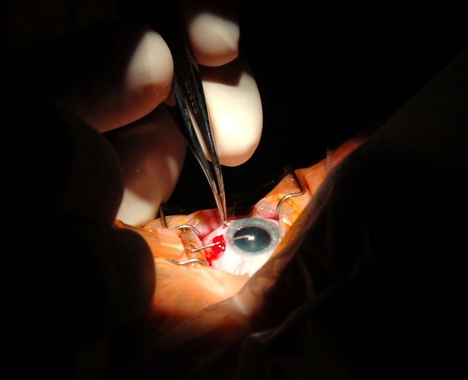 Dr. Dominic Strazzulla of Quincy performs cataract surgery in 2010 on Michelle Goldrick of Quincy.