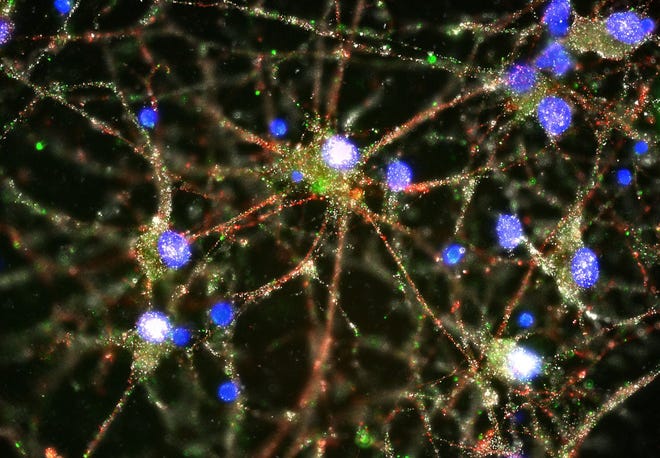 This image provided by Heather de Rivera and made with a fluorescent microscope shows C4 proteins, green, located at the synapses in a culture of human neurons. In research released on Wednesday, Jan. 27, 2016, scientists pursuing the biological roots of schizophrenia have zeroed in on a potential factor _ a normal brain process that gets kicked into overdrive. The finding could someday lead to ways to treat the disease or even prevent it. (Heather de Rivera/McCarroll Lab/Harvard via AP)