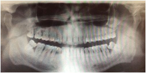This 30 year-old male patient has a lower wisdom tooth on the left that is not in good position for use and is contributing to bone loss and gum disease.  The lower right is in poor position and is also contributing to bone loss and gum disease as well as decay on the tooth in front of it.