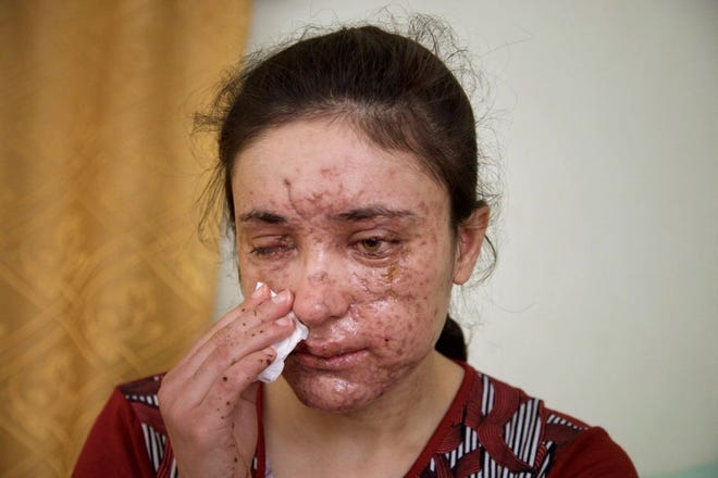 Lamiya Aji Bashar, an 18-year-old Yazidi girl who escaped her Islamic State group enslavers, talks to The Associated Press in northern Iraq in this May 5 photo. She described how she was abducted along with her sisters and brothers when IS overran her village in 2014 and was passed around from militant to militant, trying to escape many times. Finally she succeeded in March, but only after a mine exploded, killing two girls fleeing with her and leaving Bashar's face scarred and blinding her in one eye. AP Photo/Balint Szlanko