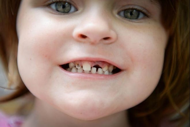 Keriana Carll, 4, recently had her front tooth pulled. Her mother, Megan Johnson, searched for months to find a dentist who was willing to accept Keriana's Medicaid insurance.