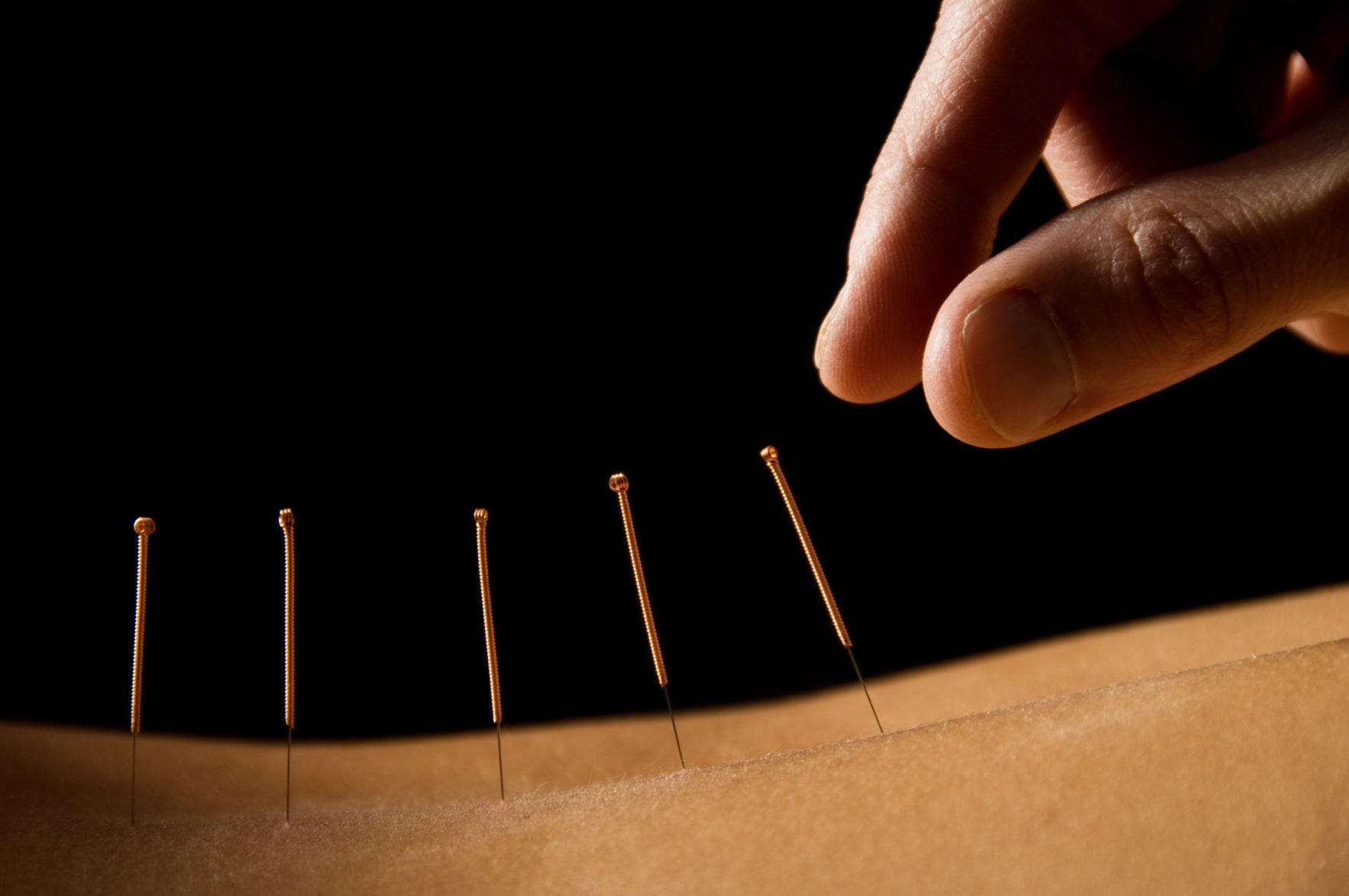 Acupuncture Ancient Chinese Healing Art Finds New Role In Modern Medicine