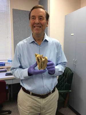 Jim Sharrock holds his heart a few months after his heart and liver transplant. After repeated heart issues, Sharrock wanted to see what his old heart looked like.