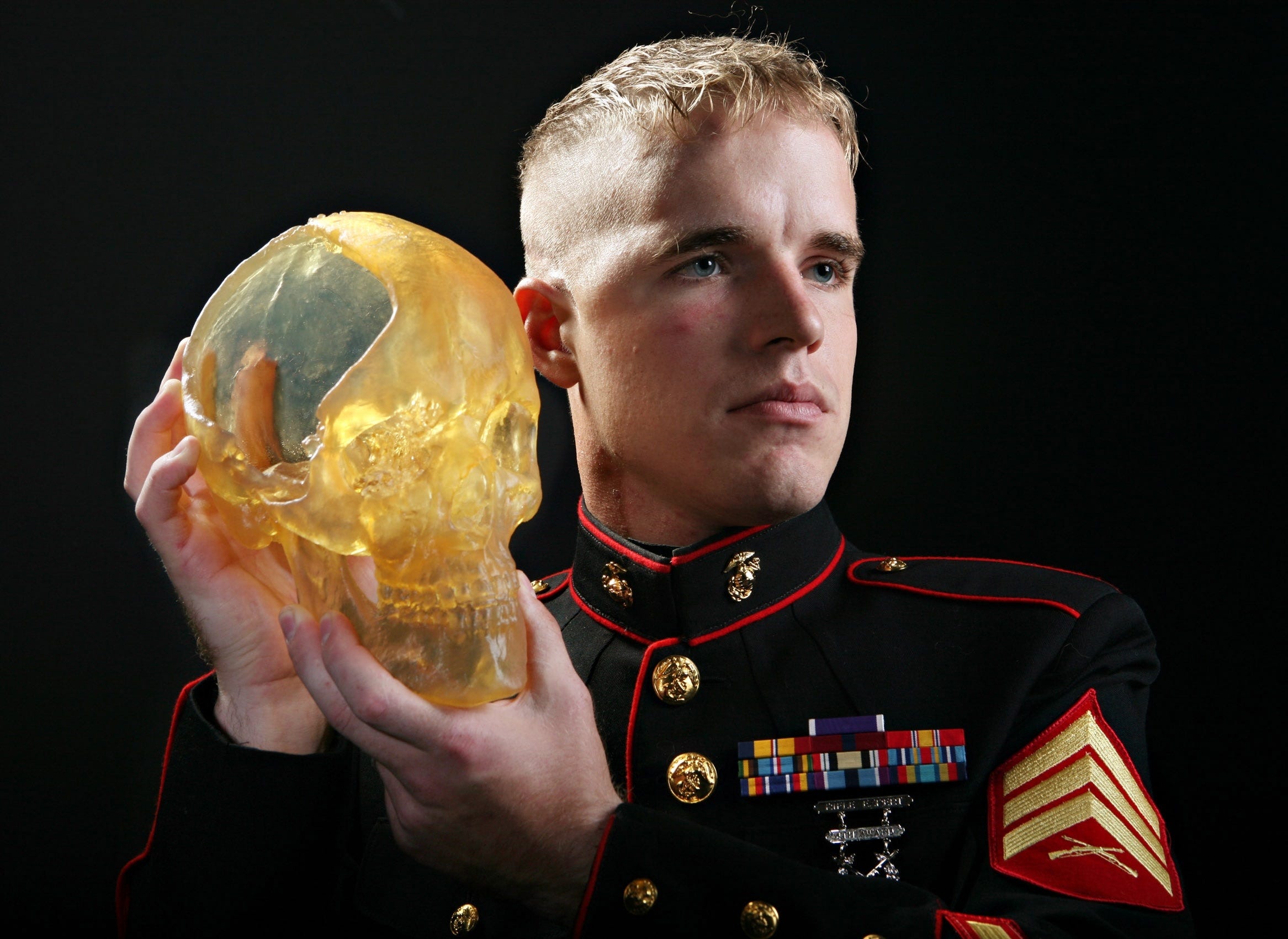 Sean DeBevoise holds a model of his skull showing the part that was removed to allow room for his brain to swell after he was shot in the head while serving in Iraq. Now, 10 years after this picture was taken, DeBevoise is trying to launch a charter fishing company. STARNEWS FILE