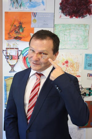 In this May 3, 2017, photo, Australian lawmaker Graham Perrett poses in his office in the city of Brisbane, Australia to show his injuries sustained three days earlier while watching the satirical U.S. TV series Veep at home. Perrett says he was stunned that he had grabbed the attention of Veep stars by simply laughing so hard at an episode of the political satire that he choked on his sushi and knocked himself unconscious on a kitchen bench. THE ASSOCIATED PRESS