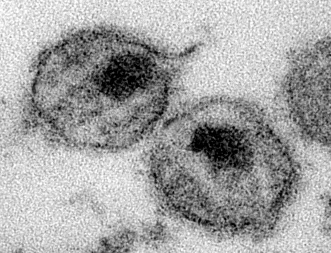 This undated electron microscope image made available by the Centers for Disease Control and Prevention shows human immunodeficiency virus particles (virions). On Thursday, June 1, 2017 the CDC changed its guidance for HIV-infected men who want to father children, saying thereþÄôs now enough evidence that a lab technique that removes the virus is a safe option. THE ASSOCIATED PRESS