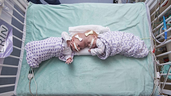 DDS THE TWINS' FAMILY NAME OF DELANEY - This September 2016 photo provided by the Children's Hospital of Philadelphia shows conjoined twin girls Abby Delaney, right, and Erin at the Children's Hospital of Philadelphia in Philadelphia. Hospital officials say surgeons successfully separated the 10-month-old twins June 6, 2017, during an 11-hour surgery. (Ed Cunicelli/Children's Hospital of Philadelphia via AP)