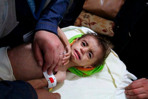 FILE - In this file photo provided on Monday, October 30, 2017 by UN Office for the Coordination of Humanitarian Affairs (OCHA), shows a severely malnourished child at the al-Kahef hospital in Kafr Batna, Eastern Ghouta near Damascus, Syria. Aid groups say the Syrian government is allowing the evacuation of nearly 30 critically ill Syrians from a besieged suburb of Damascus, where hundreds of people requiring medical treatment have been prevented from reaching hospitals minutes away. The government recently tightened its siege of eastern Ghouta, home to some 400,000 people, leading to severe shortages of food, fuel and medicine as winter sets in. (UN OCHA via AP, File)