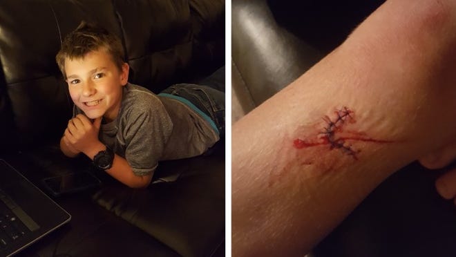 Caden Walsh, 10, was hit Friday on his walk home from Forest North Elementary School when he was struck by a hit-and-run driver, his mother says. He had to get 10 stitches below his knee. Photos courtesy of Heather Brady