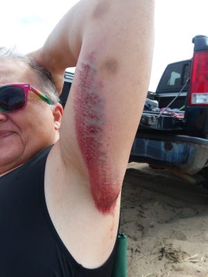 Cindy Mackenzie suffered painful scrapes and bruises after she was sucked into a culvert near the Hatches Harbor Race Run inlet in Provincetown. [Photo courtesy Annie Gauger]