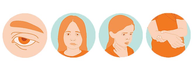 Symptoms of AFM include difficulty moving the eyes or drooping eyelids, facial droop or weakness, difficulty with swallowing or slurred speech, sudden arm or leg weakness. Seek medical care right away if your child has any of these symptoms. [Source:Centers for Disease Control and Prevention]