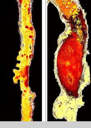 This shows a treated aneurysm, left, and an untreated one. [GLOBE NEWSWIRE]