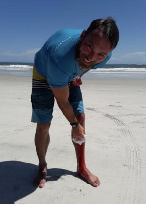 Donald Walsh, of Mims, suffered shark bites while surfing at the inlet in New Smyrna Beach on Tuesday. He caught air on a wave and landed on a shark, said officials with the Volusia County Beach Safety Ocean Rescue. [Donald Walsh]