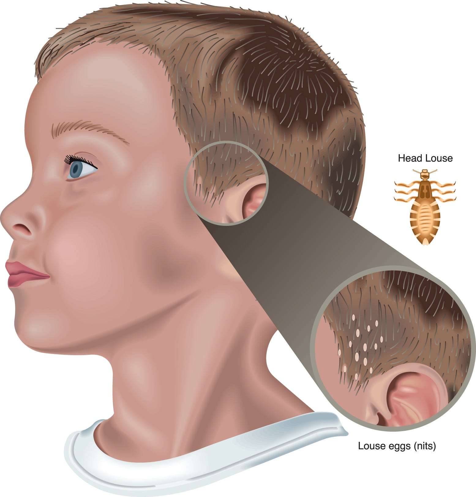 How to scratch head lice off your list of worries