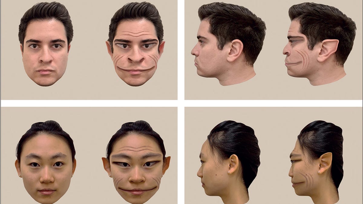 是什么导致了面部变形，即罕见的“魔鬼脸”综合症（PMO）。