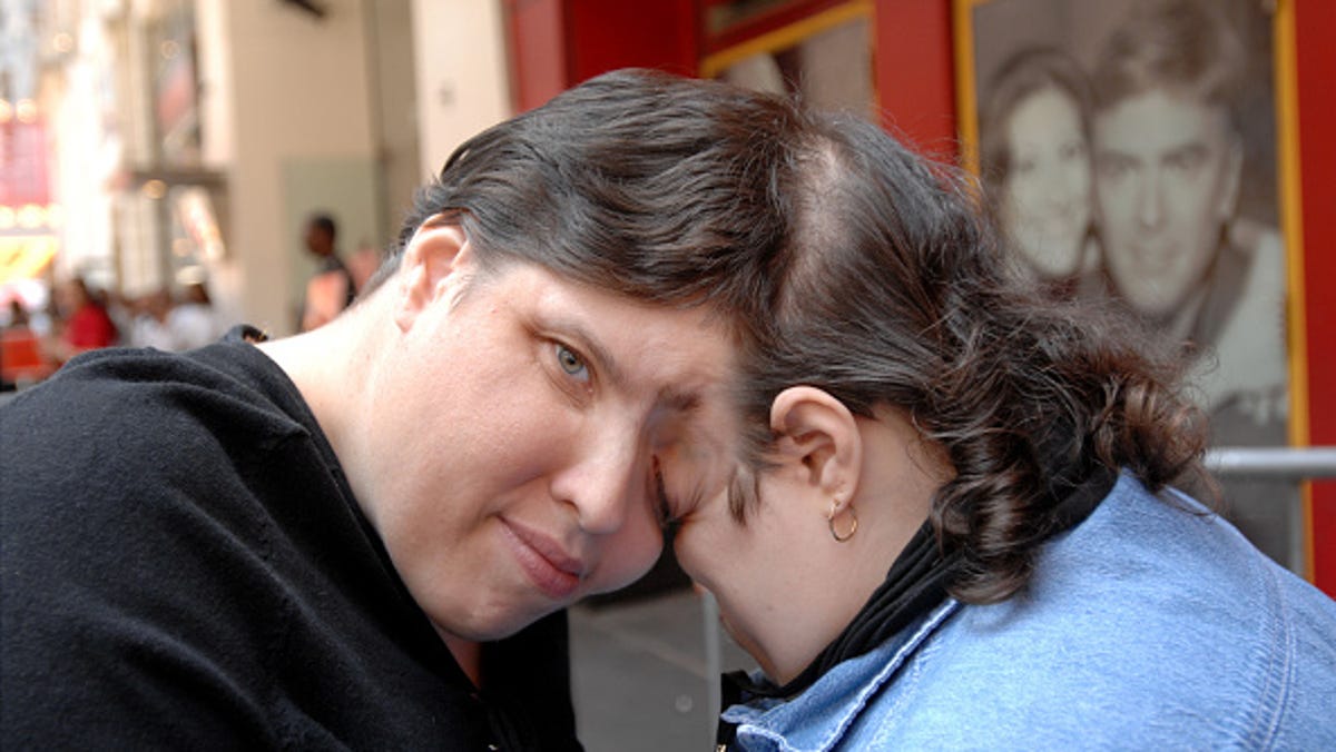 Lori and George Schappell, the world’s oldest conjoined twins, pass away at the age of 62