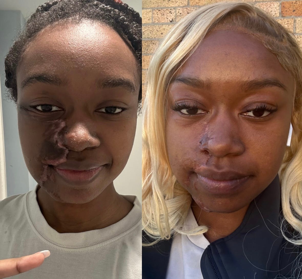 Juanita Jimenez, an acid attack survivor, opens up about the 2022 experience.