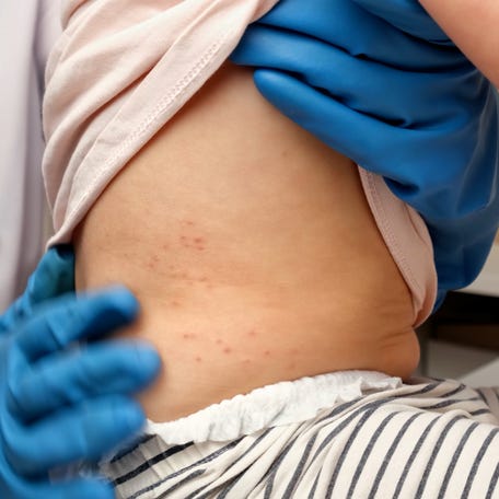 As of Jan. 22, 2026, 416 confirmed measles cases have been reported in the United States for the new year, according to the Centers for Disease Control and Prevention. In 2025, there were 2,255 confirmed measles cases. More than 90% of the cases were unvaccinated or unknown.