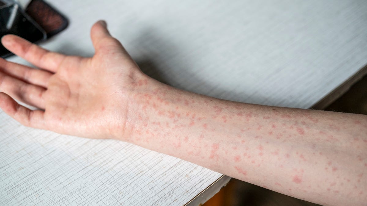 What is the MMR vaccine? What experts need you to know What is the MMR vaccine? What experts need you to know