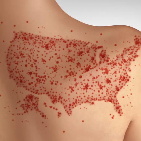 Measles cases have hit a "plateau," the CDC said on June 25, 2025.