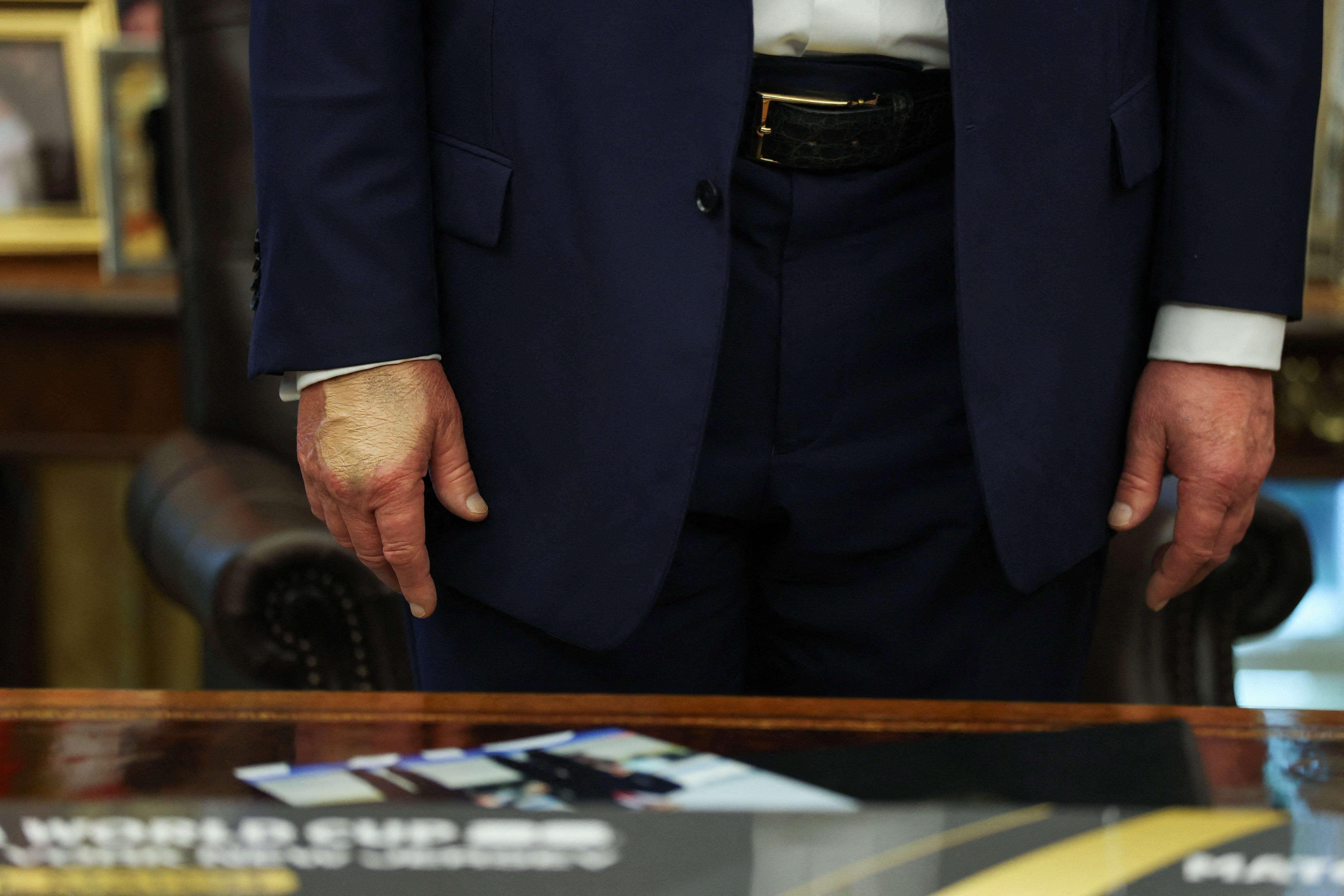 Here’s what the White House has said about Trump’s hand makeup, bruise