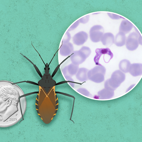 Once thought to be limited to Latin America, Chagas or Kissing bug disease has been reported in over 30 states.