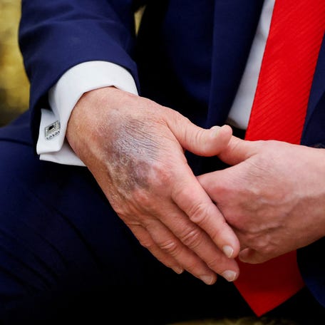 The bruised right hand of U.S. President Donald Trump is visible during a meeting with South Korean President Lee Jae Myung at the Oval Office, at the White House, in Washington, D.C., U.S., August 25, 2025.