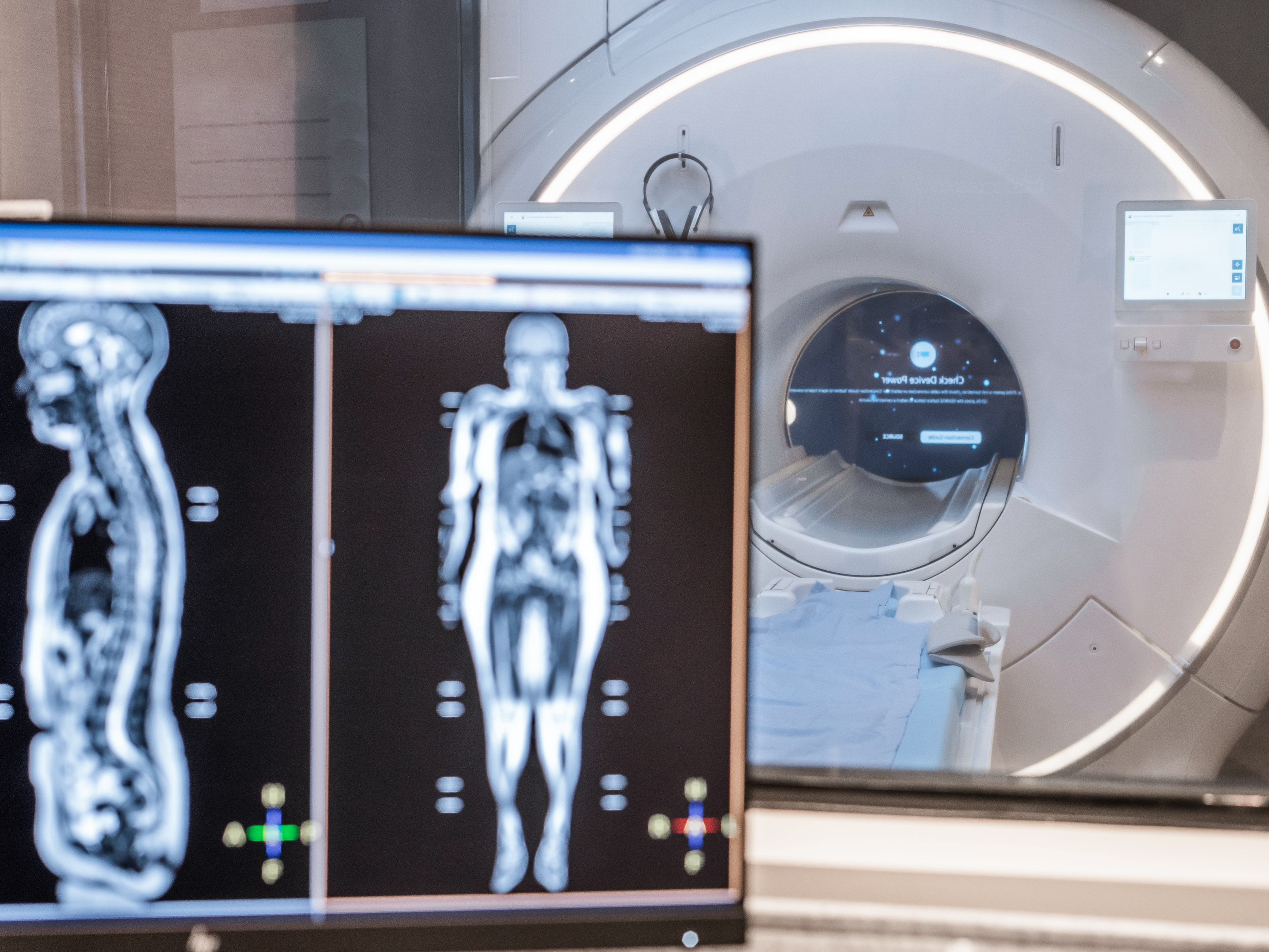 Full-body MRIs and how often they find cancer, aneurysms
