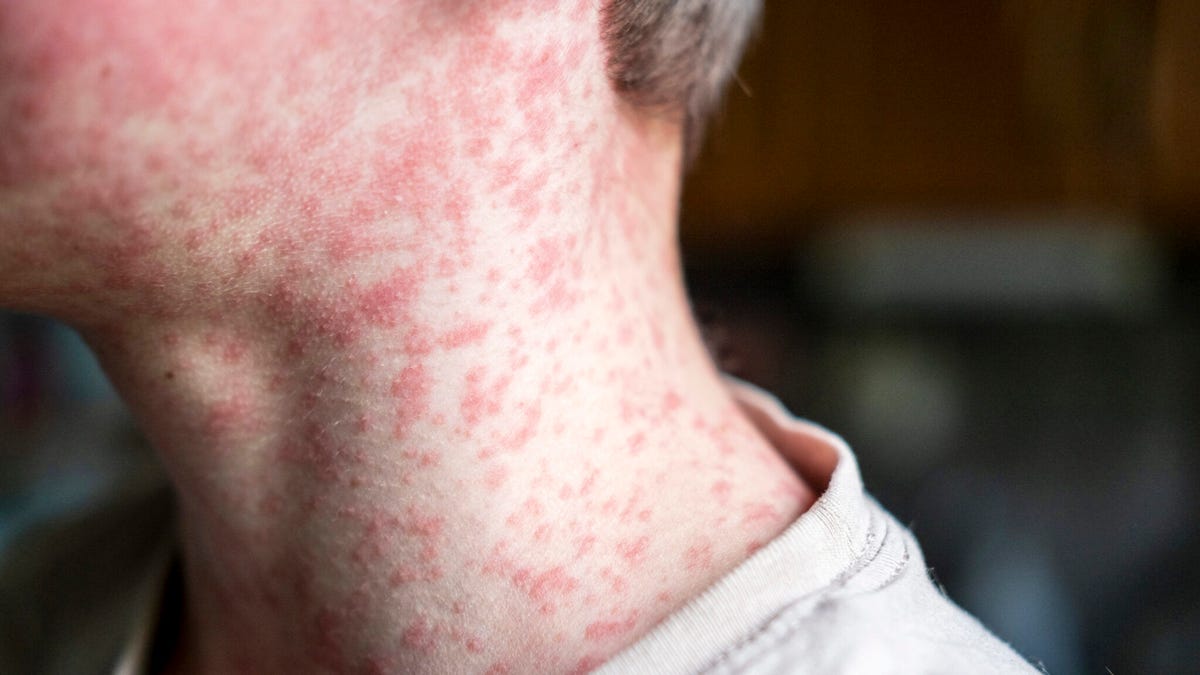 Measles can cause immune amnesia. Measles can cause immune amnesia.