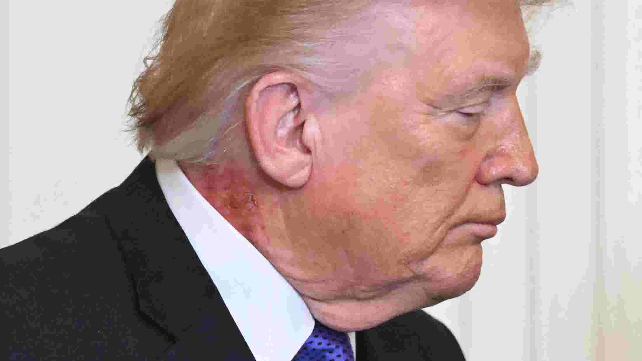White House sidesteps question on Trump neck rash