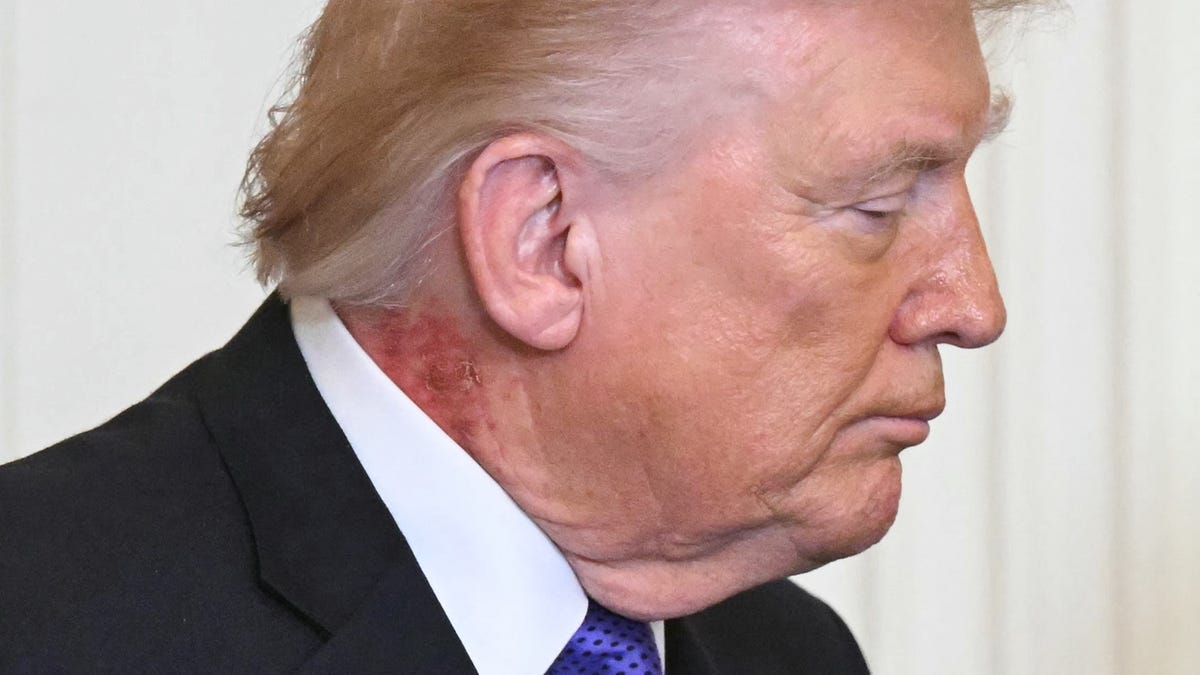 Images show rash on President Trump's neck. What is it?
