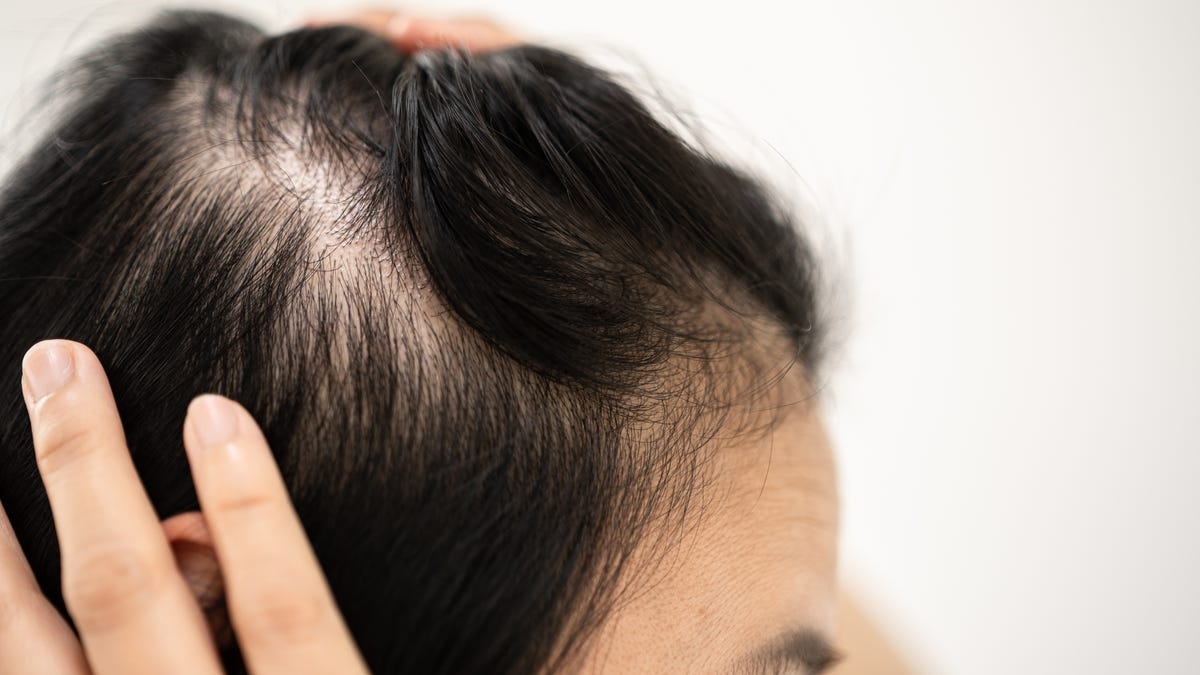 How does hair loss differ between men and women?