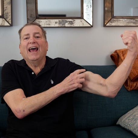 Tim Andrews shows off his arteriovenous fistula that was created in a surgical procedure for dialysis while sitting for a portrait at his home in Concord, NH, on March 10, 2026. With his human kidney transplant, Andrews no longer needs dialysis.