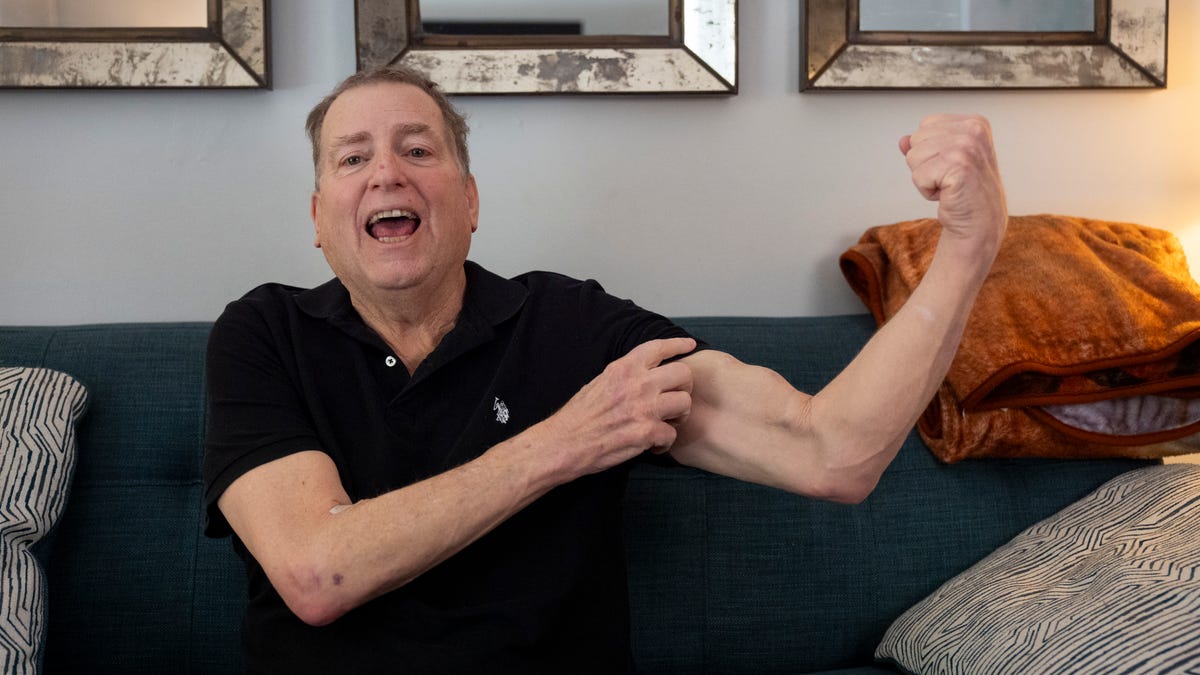 Tim Andrews shows off his arteriovenous fistula that was created in a surgical procedure for dialysis while sitting for a portrait at his home in Concord, NH, on March 10, 2026. With his human kidney transplant, Andrews no longer needs dialysis.