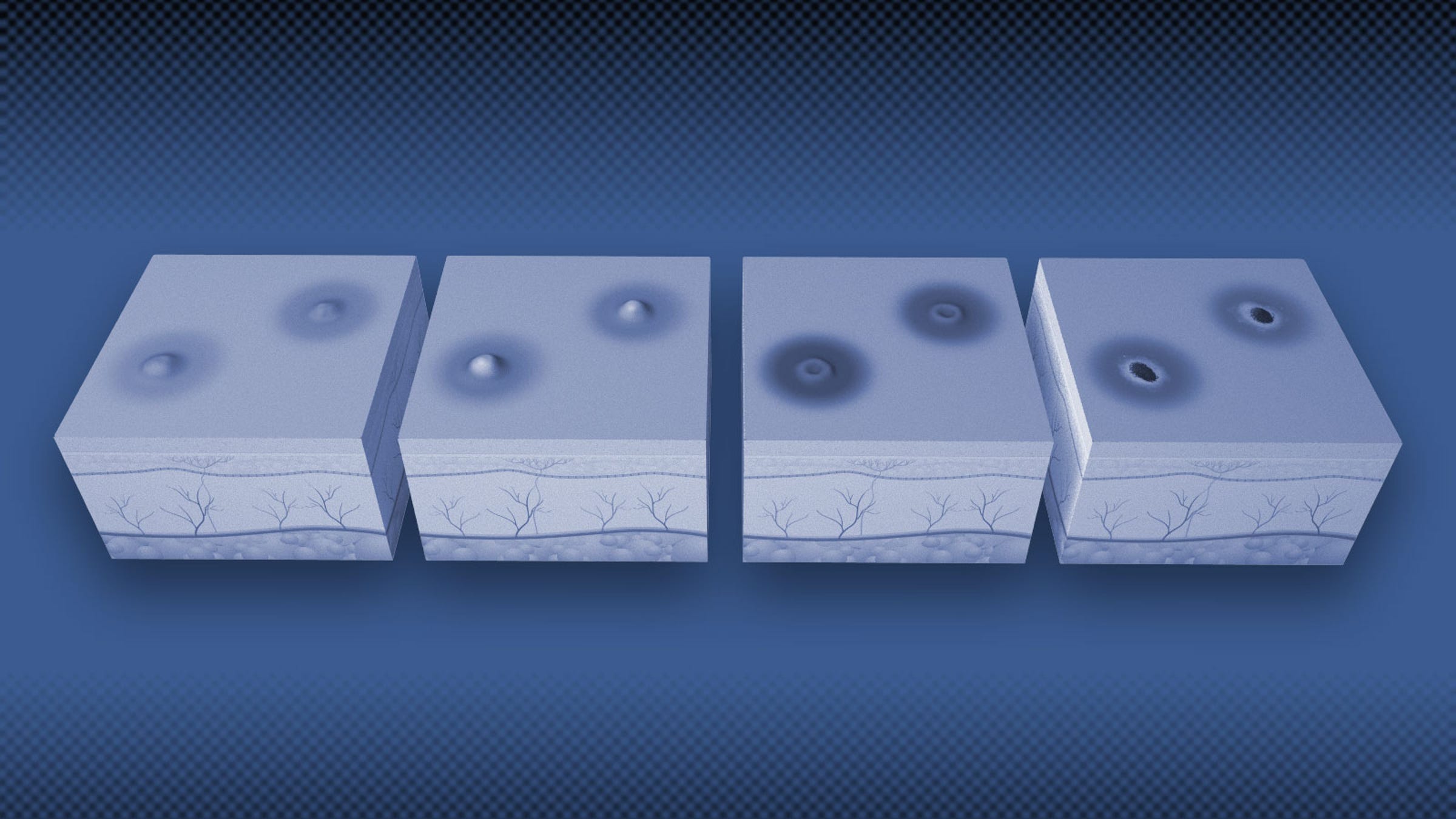 What does monkeypox rash look like? A visual guide to how it spreads